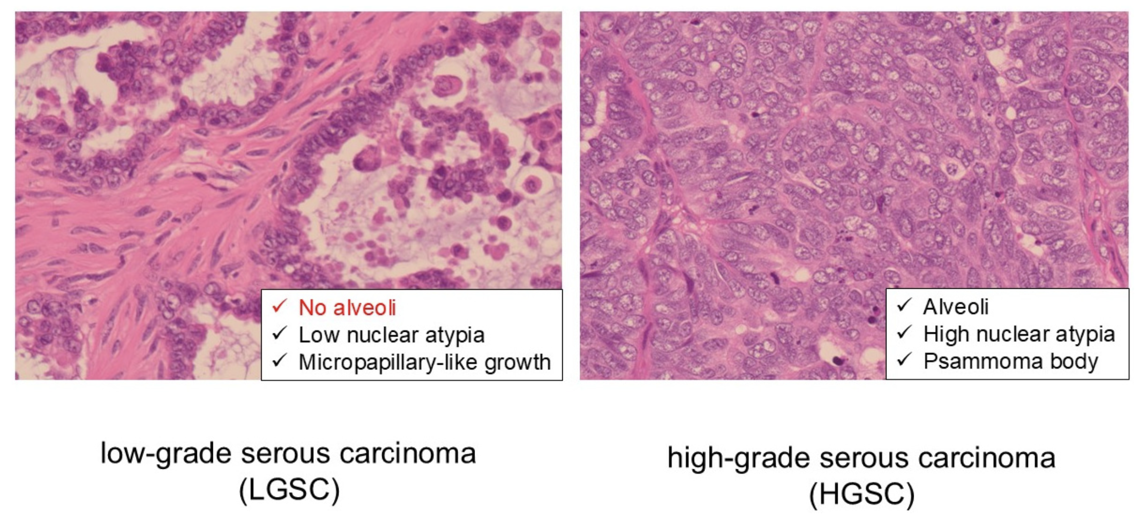 Recent clinical and molecular findings in low-grade serous ovarian ...